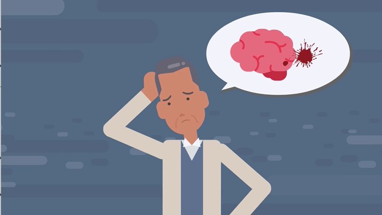 【医師解説】脳出血の初期症状とは?原因や治療は?【クモ膜下出血】