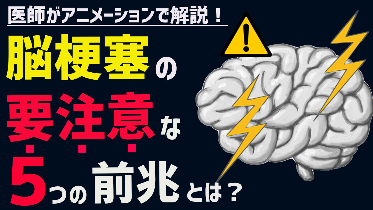 脳梗塞の初期症状・前兆をチェック!原因や予防法、治療は?【医師解説】